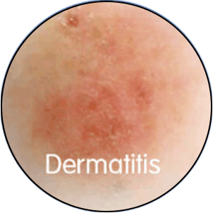 Hautanalyse-Kreuzpolarisiert-Dermatitis