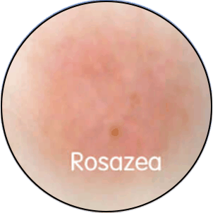 Hautanalyse-Kreuzpolarisiert-Rosazea