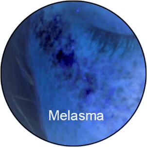 Hautanalyse-UV-Licht-Melasma
